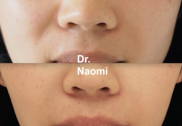 Before and after nasolabial fold treatment
