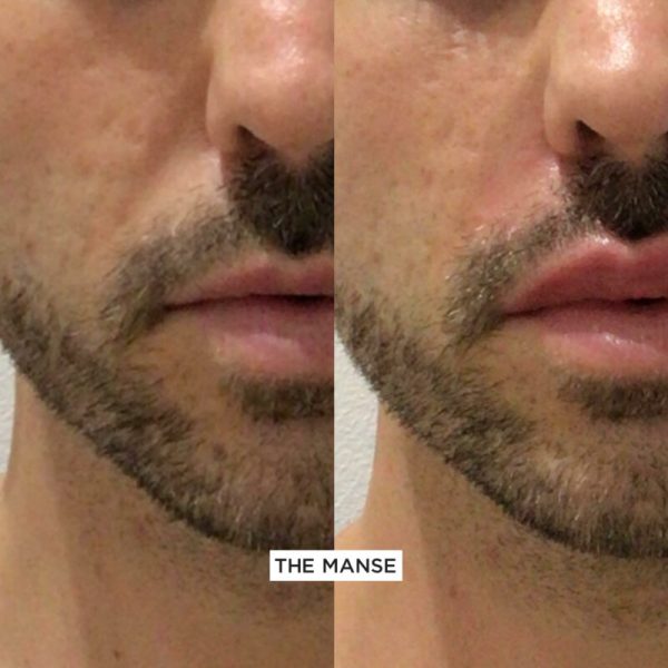 Before and after nasolabial treatment