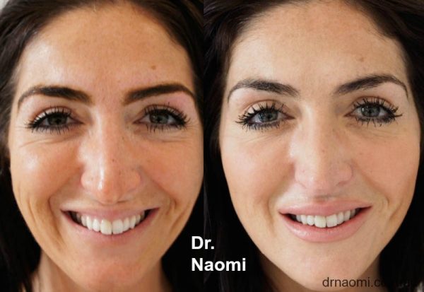 Before and after non-surgical facelift
