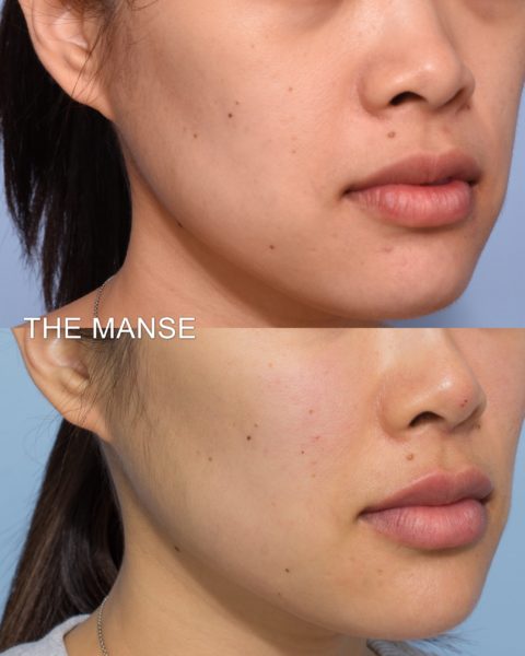 Before and after non-surgical facelift