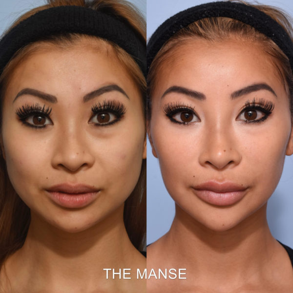 Before and after non-surgical facelift asian face