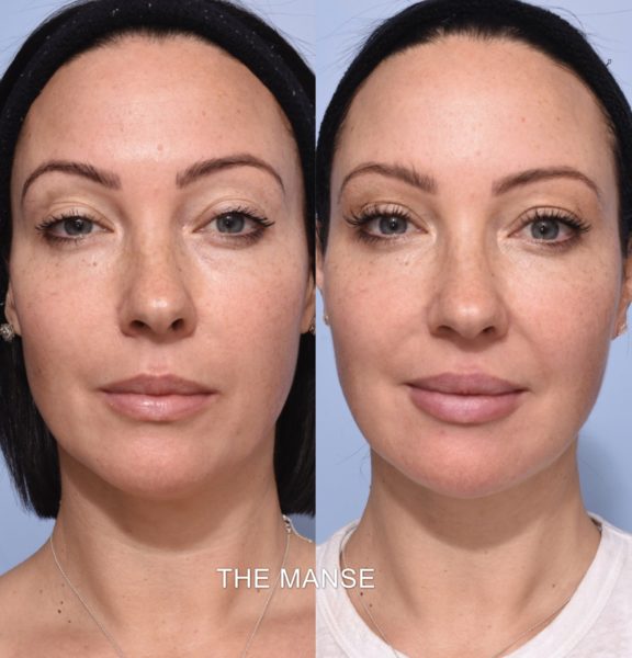 Before and after non-surgical facelift including temples