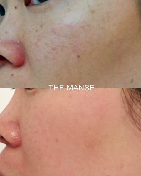 Before and after pigmentation treatment