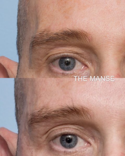 Before and after plasma pen and treatment to temples