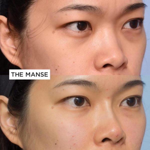 Before and after tear trough and cheek treatments and non-surgical rhinoplasty