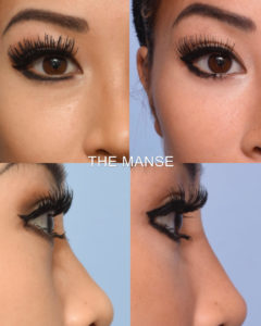 Before and after tear trough area treatments