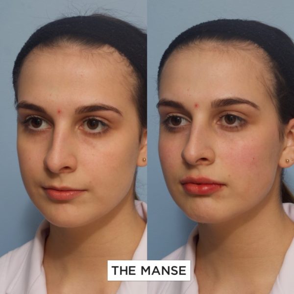 Before and after tear trough, cheeks and lip treatments