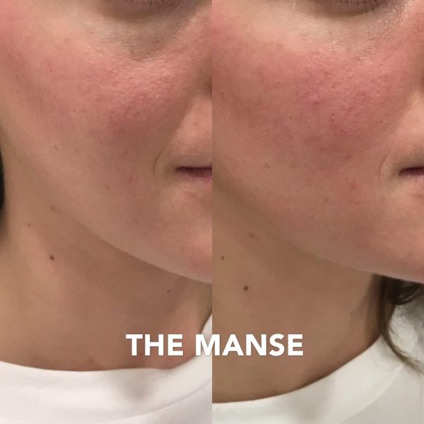 Before and after tear trough treatment