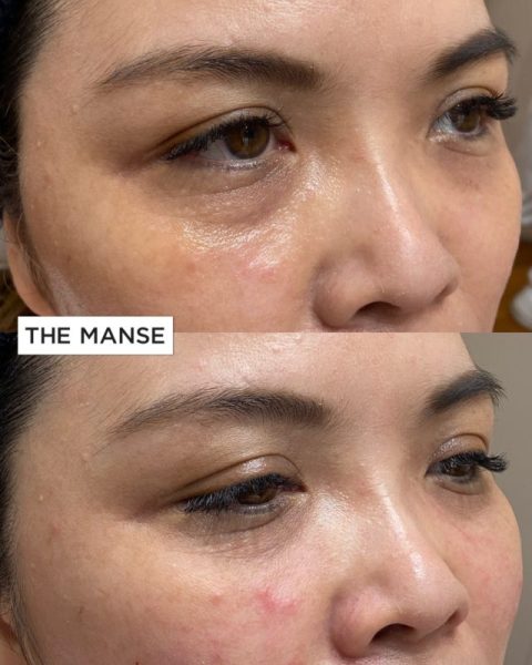 Before and after tear trough treatments