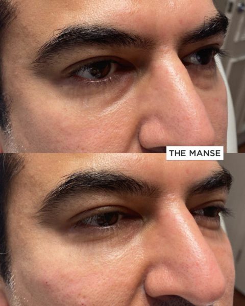 Before and after tear trough treatments