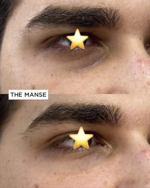 Before and after tear trough treatments