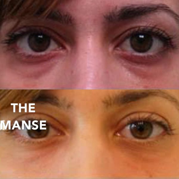 Before and after tear trough treatments