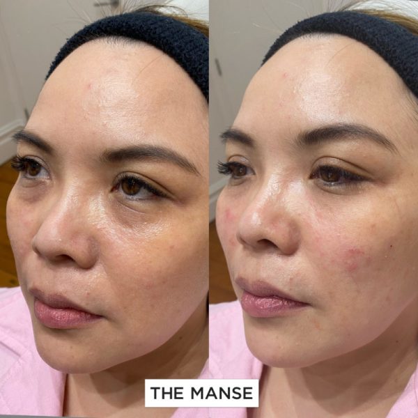 Before and after tear trough treatments