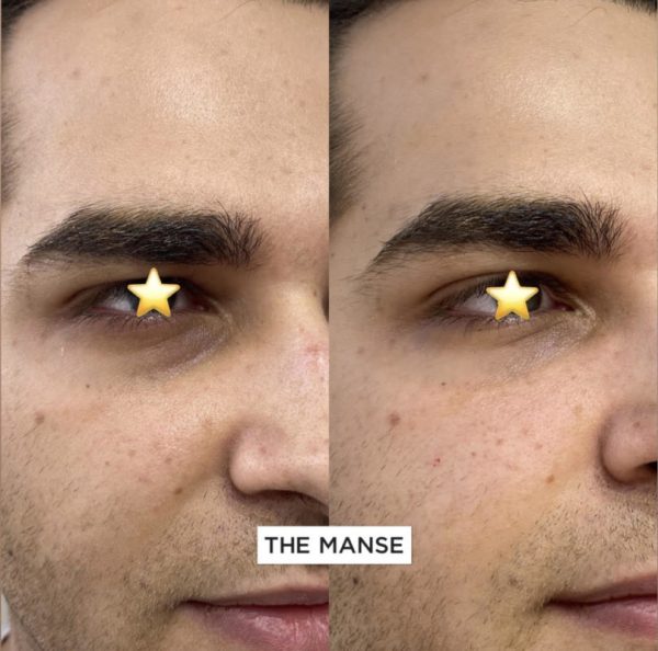 Before and after tear trough treatments in a male