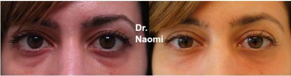 Before and after tear troughs treatment, further treatment will achieve an even better result