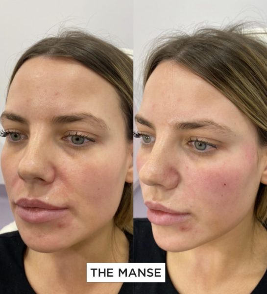 Before and after temple, nasolabial fold, cheeks, tear troughs and jawline treatments