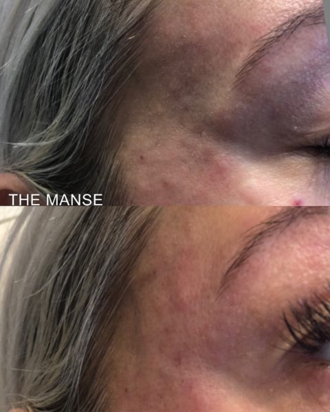Before and after temple treatment