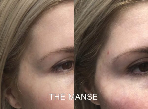 Before and after temple treatment