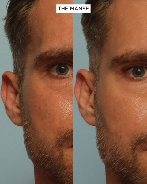 Before and after temple treatments