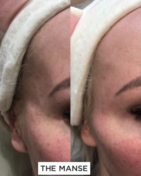 Before and after temple treatments