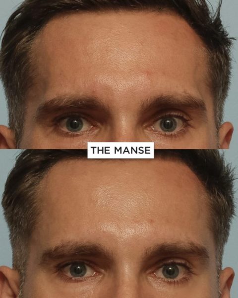 Before and after temple treatments