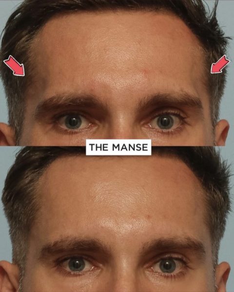 Before and after temple treatments male