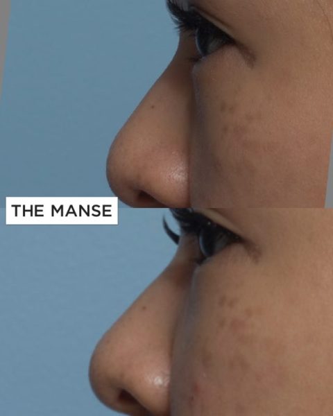 Before and after treatment