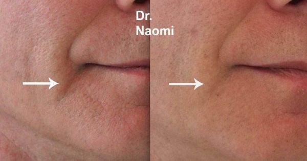 Before and after treatment