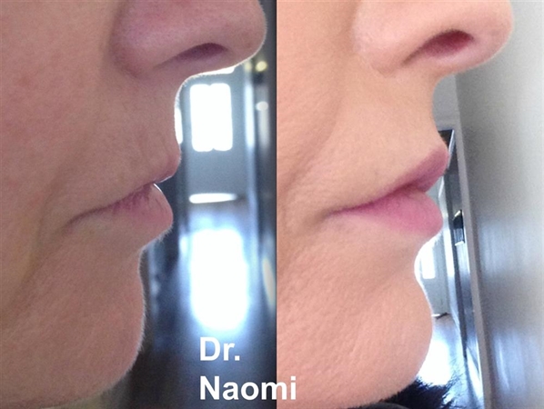 Before and after treatment for aging chin
