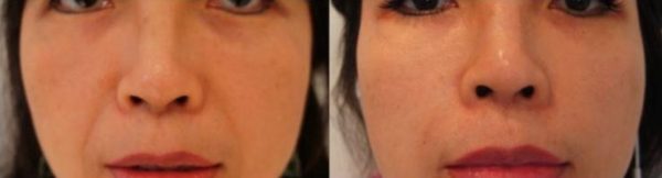 Before and after treatment for cheeks and the nasolabial folds