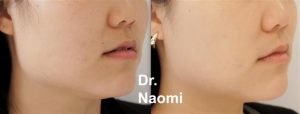 Before and after treatment for masseters, the squareness of the jaw has been reduced