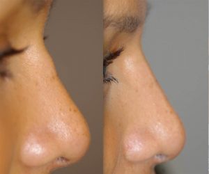 Before and after treatment in nose to disguise bump in nose from previous rhinoplasty surgery
