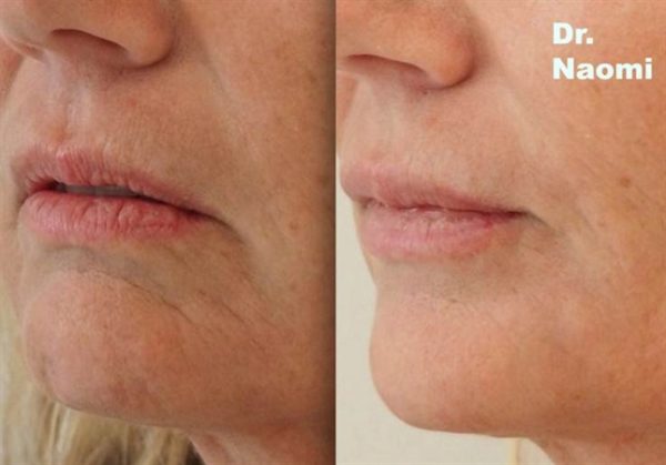 Before and after treatment of marionette lines