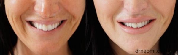Before and after treatment to reduce lines around mouth, including accordion lines nasolabial folds and marionettes