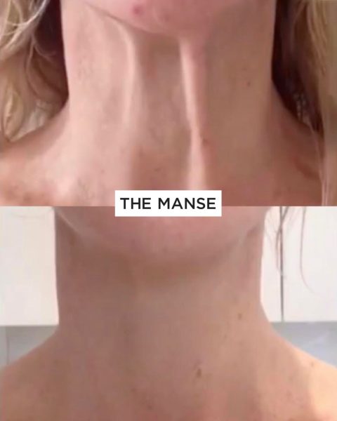 Before and after treatment to relax visible neck bands