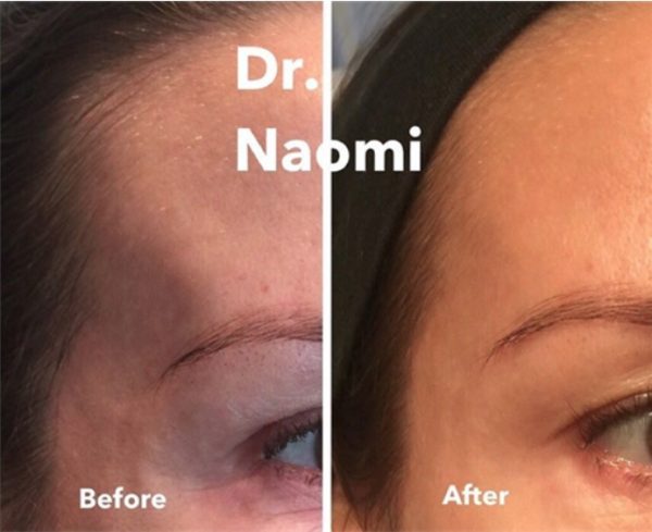 Before and after treatment to temples