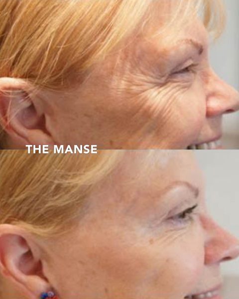 Before and after treatment to the crow’s feet and cheek area. The patient also received volume restoration treatment