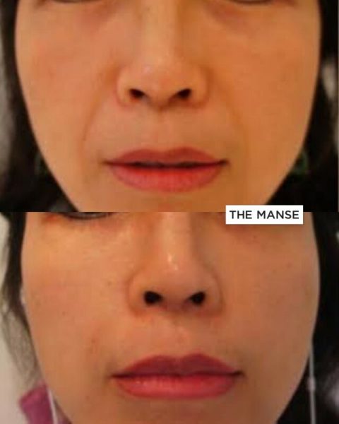 Before and after treatments, cheeks and Nasolabial fold