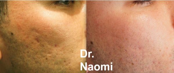 Before and after treatments for acne scarring