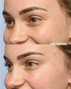 Before and after treatments for crows feet