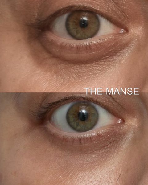 Before and after treatments for dark circles and under eye wrinkles