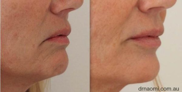Before and after treatments for lower face for sagging jowls and downturned mouth