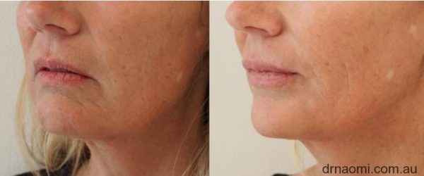 Before and after treatments for marionettes and jawline