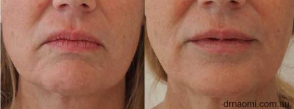 Before and after treatments in lower face for jowls and sag
