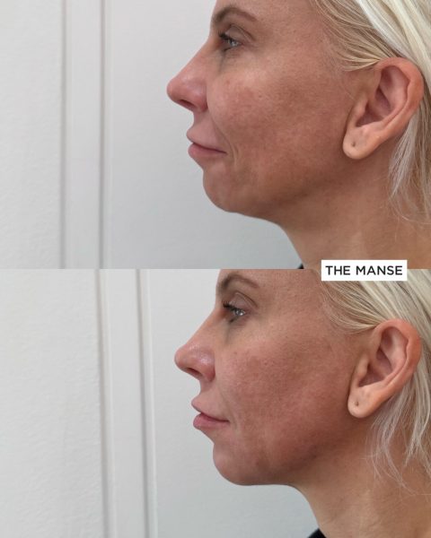 Before and after treatments including chin