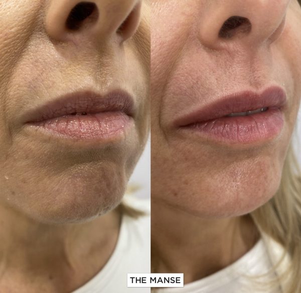 Before and after treatments including chin