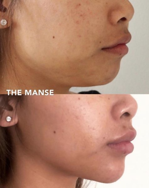 Before and after treatments including chin