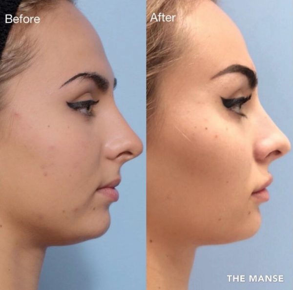 Before and after treatments including chin