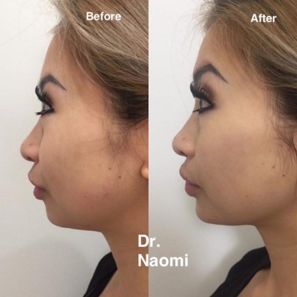Before and after treatments including chin
