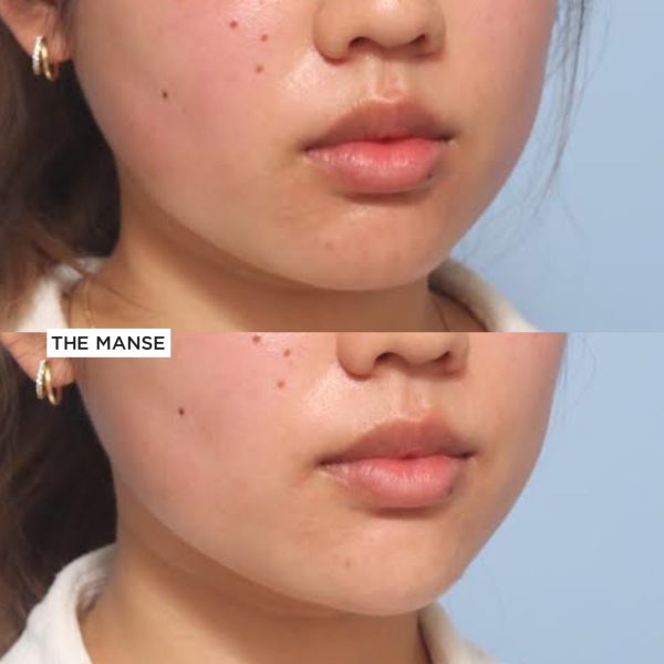Before and after treatments including chin